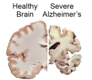 Alzheimer and healthy brain comparison